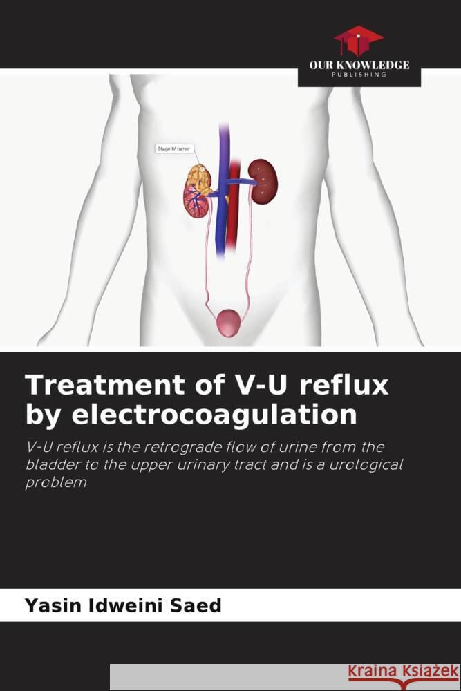 Treatment of V-U reflux by electrocoagulation Yasin Idweini Saed 9786206879558