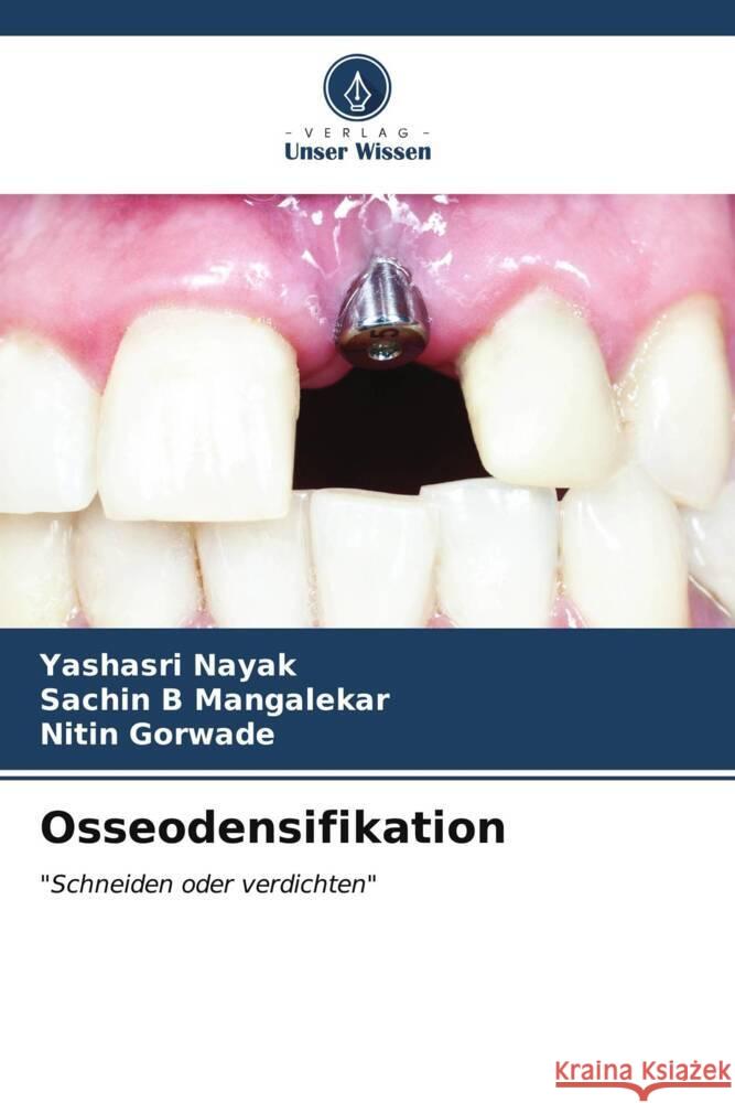 Osseodensifikation Yashasri Nayak Sachin B. Mangalekar Nitin Gorwade 9786206892915