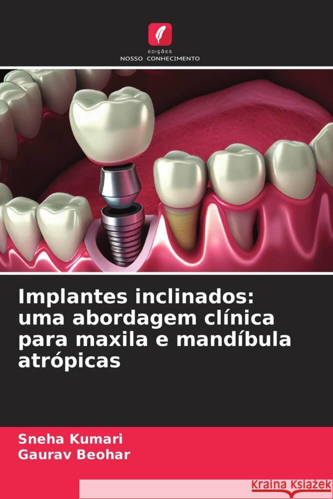 Implantes inclinados: uma abordagem cl?nica para maxila e mand?bula atr?picas Sneha Kumari Gaurav Beohar 9786206903703