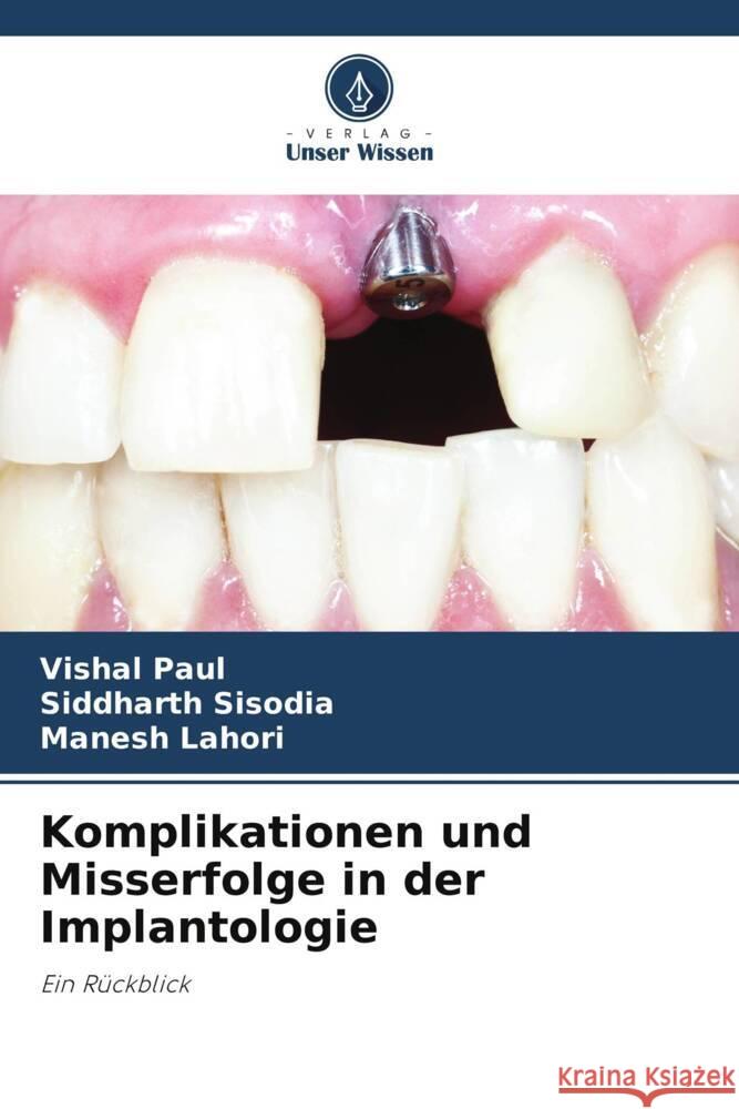 Komplikationen und Misserfolge in der Implantologie Vishal Paul Siddharth Sisodia Manesh Lahori 9786206907367