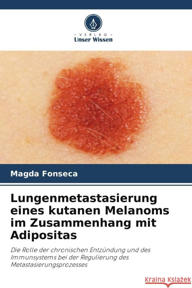 Lungenmetastasierung eines kutanen Melanoms im Zusammenhang mit Adipositas Magda Fonseca 9786206909309