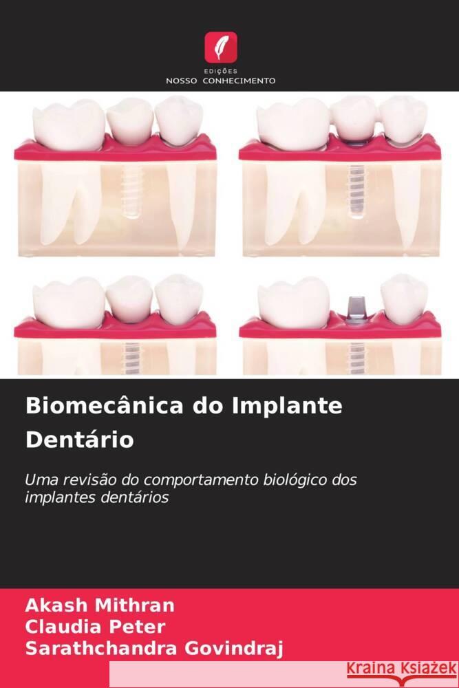 Biomecânica do Implante Dentário Mithran, Akash, Peter, Claudia, GOVINDRAJ, Sarathchandra 9786206943792