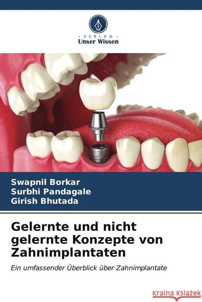 Gelernte und nicht gelernte Konzepte von Zahnimplantaten Swapnil Borkar Surbhi Pandagale Girish Bhutada 9786206947677