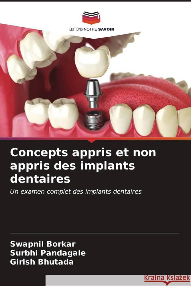 Concepts appris et non appris des implants dentaires Swapnil Borkar Surbhi Pandagale Girish Bhutada 9786206947684