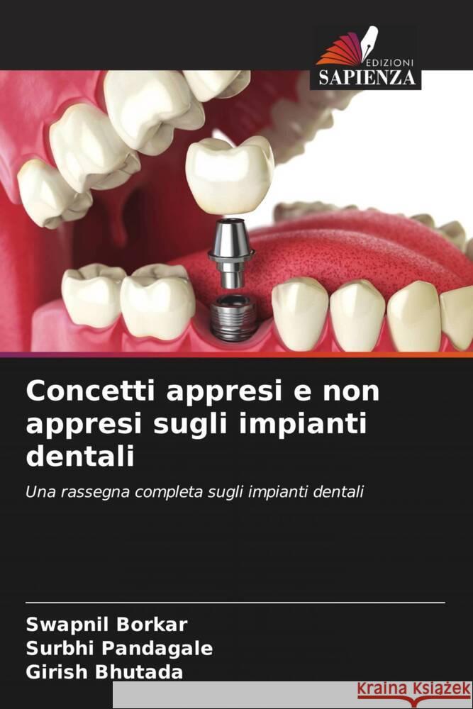 Concetti appresi e non appresi sugli impianti dentali Swapnil Borkar Surbhi Pandagale Girish Bhutada 9786206947707