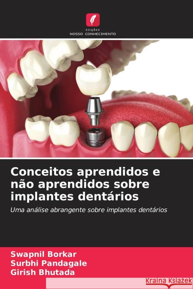 Conceitos aprendidos e n?o aprendidos sobre implantes dent?rios Swapnil Borkar Surbhi Pandagale Girish Bhutada 9786206947714