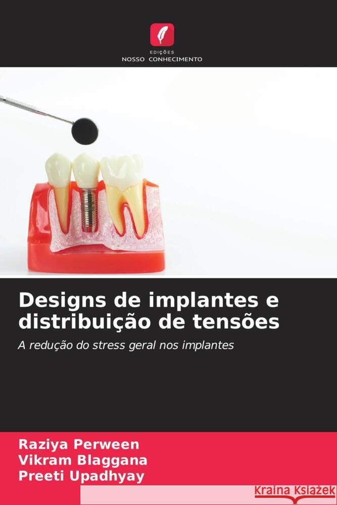 Designs de implantes e distribui??o de tens?es Raziya Perween Vikram Blaggana Preeti Upadhyay 9786206951131