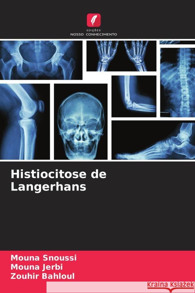 Histiocitose de Langerhans Mouna Snoussi Mouna Jerbi Zouhir Bahloul 9786206974611 Edicoes Nosso Conhecimento