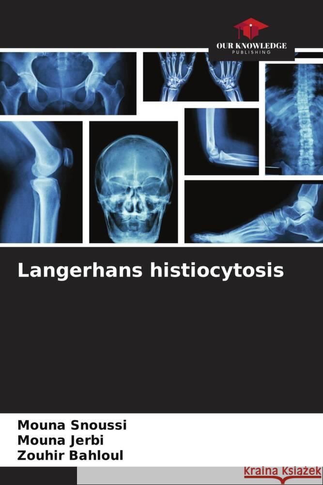 Langerhans histiocytosis Mouna Snoussi Mouna Jerbi Zouhir Bahloul 9786206974697 Our Knowledge Publishing