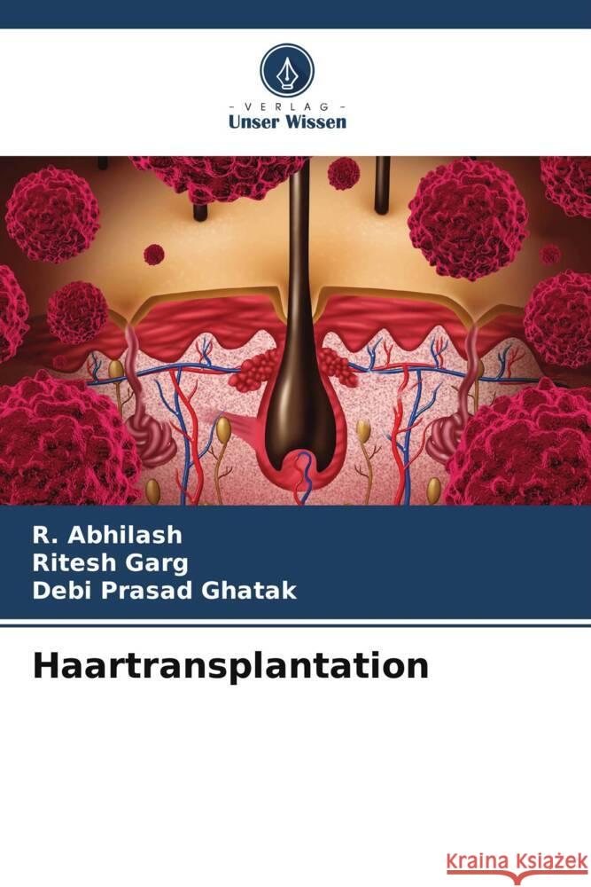 Haartransplantation R. Abhilash Ritesh Garg Debi Prasad Ghatak 9786206994930