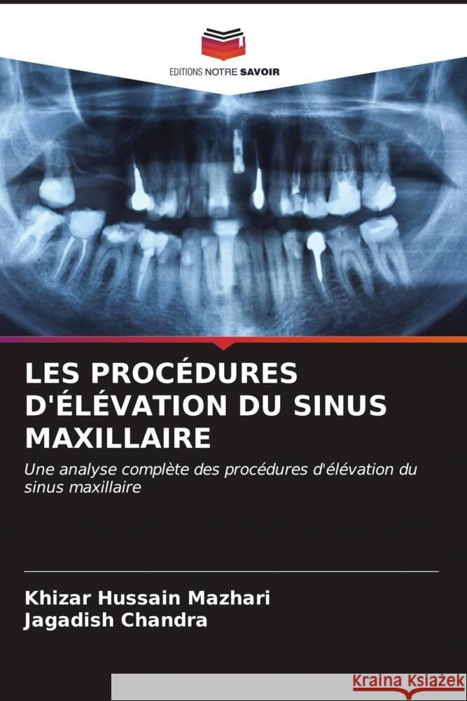 Les Proc?dures d'?l?vation Du Sinus Maxillaire Khizar Hussain Mazhari Jagadish Chandra 9786207045570