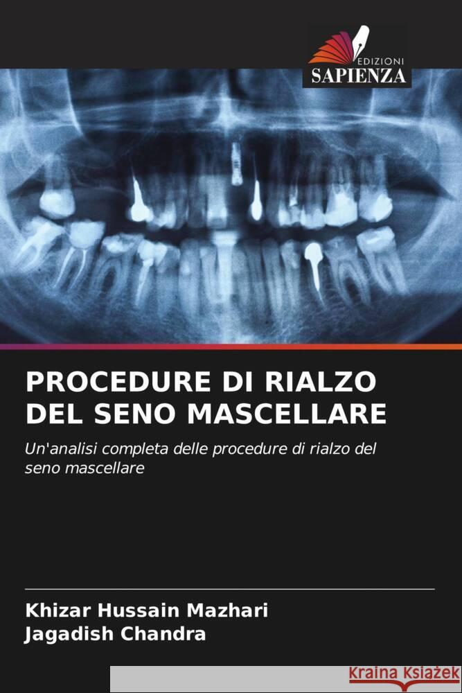 Procedure Di Rialzo del Seno Mascellare Khizar Hussain Mazhari Jagadish Chandra 9786207045594