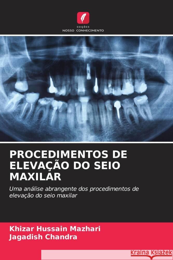 Procedimentos de Eleva??o Do Seio Maxilar Khizar Hussain Mazhari Jagadish Chandra 9786207045679