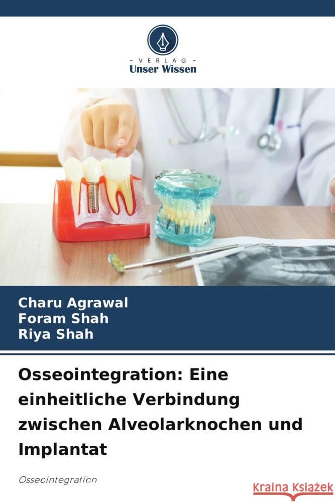 Osseointegration: Eine einheitliche Verbindung zwischen Alveolarknochen und Implantat Charu Agrawal Foram Shah Riya Shah 9786207048182