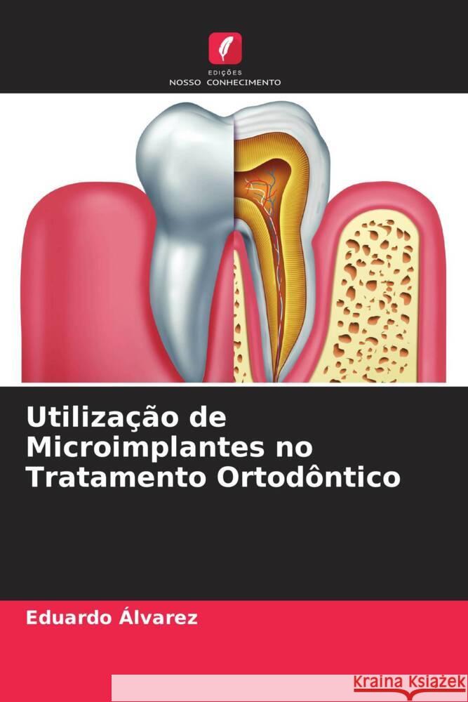 Utiliza??o de Microimplantes no Tratamento Ortod?ntico Eduardo ?lvarez 9786207057566 Edicoes Nosso Conhecimento