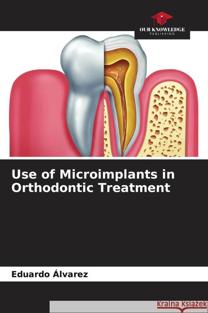 Use of Microimplants in Orthodontic Treatment Eduardo ?lvarez 9786207057634 Our Knowledge Publishing