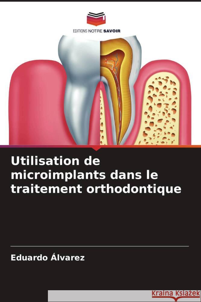 Utilisation de microimplants dans le traitement orthodontique Eduardo ?lvarez 9786207057658 Editions Notre Savoir