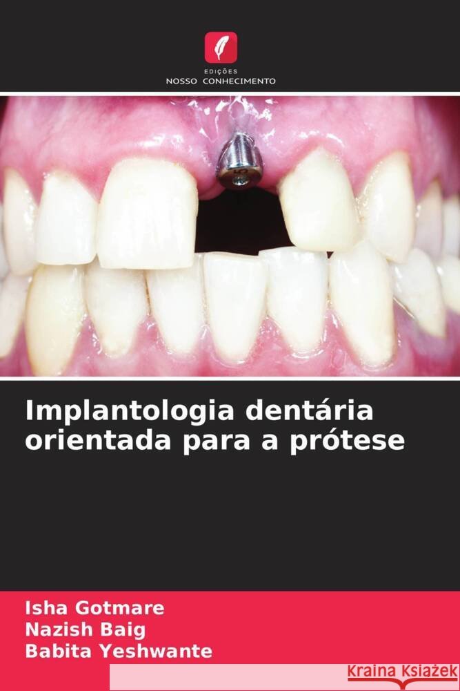 Implantologia dent?ria orientada para a pr?tese Isha Gotmare Nazish Baig Babita Yeshwante 9786207077755
