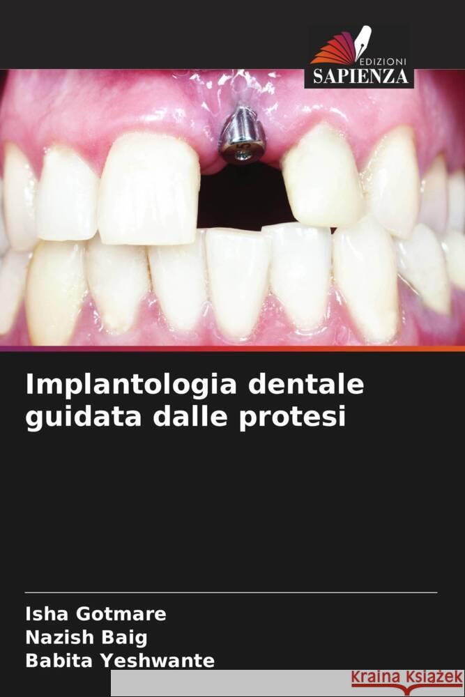 Implantologia dentale guidata dalle protesi Isha Gotmare Nazish Baig Babita Yeshwante 9786207077885 Edizioni Sapienza