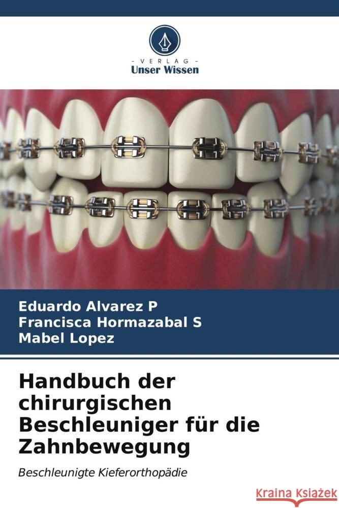 Handbuch der chirurgischen Beschleuniger für die Zahnbewegung Alvarez P, Eduardo, Hormazabal S, Francisca, Lopez, Mabel 9786207086184