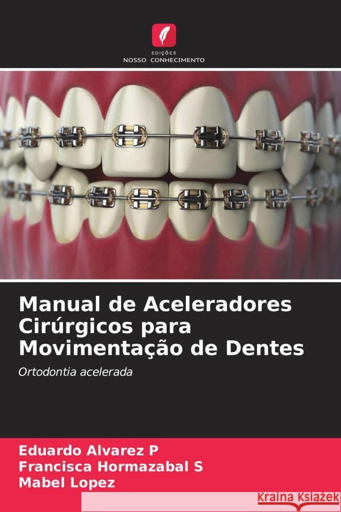 Manual de Aceleradores Cirúrgicos para Movimentação de Dentes Alvarez P, Eduardo, Hormazabal S, Francisca, Lopez, Mabel 9786207086252