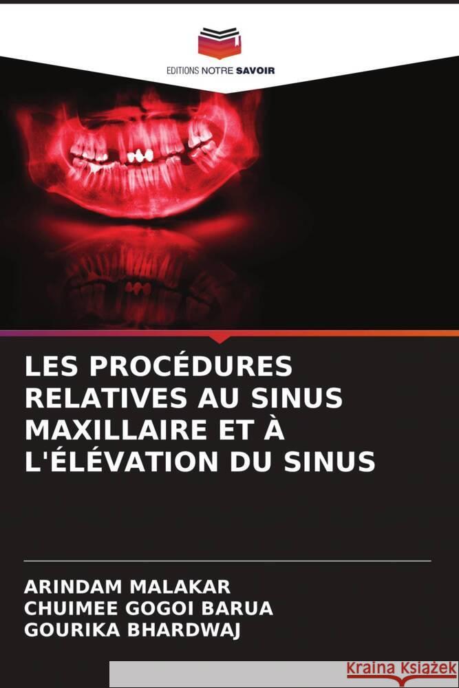 LES PROCÉDURES RELATIVES AU SINUS MAXILLAIRE ET À L'ÉLÉVATION DU SINUS Malakar, Arindam, Barua, Chuimee Gogoi, BHARDWAJ, GOURIKA 9786207095803