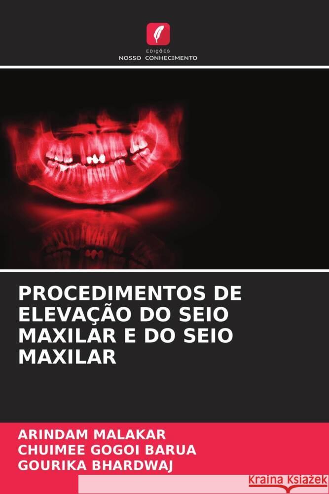 PROCEDIMENTOS DE ELEVAÇÃO DO SEIO MAXILAR E DO SEIO MAXILAR Malakar, Arindam, Barua, Chuimee Gogoi, BHARDWAJ, GOURIKA 9786207095827