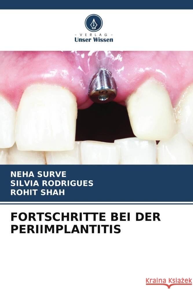 FORTSCHRITTE BEI DER PERIIMPLANTITIS SURVE, NEHA, Rodrigues, Silvia, Shah, Rohit 9786207096206