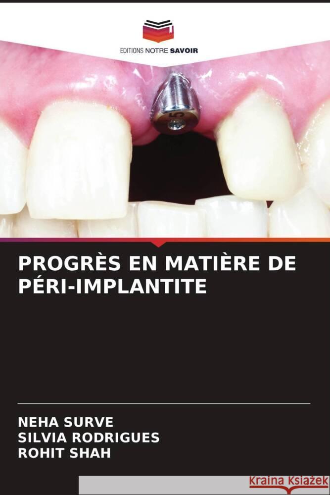 PROGRÈS EN MATIÈRE DE PÉRI-IMPLANTITE SURVE, NEHA, Rodrigues, Silvia, Shah, Rohit 9786207096220