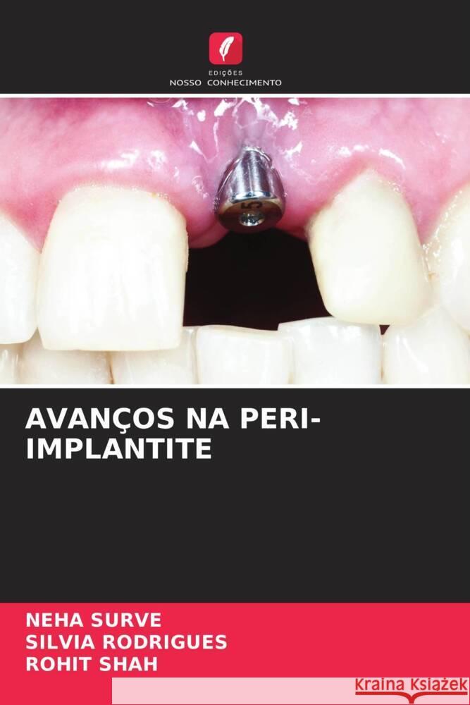 AVANÇOS NA PERI-IMPLANTITE SURVE, NEHA, Rodrigues, Silvia, Shah, Rohit 9786207096244