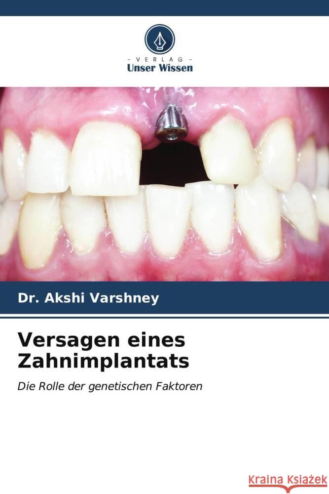 Versagen eines Zahnimplantats Akshi Varshney 9786207139583