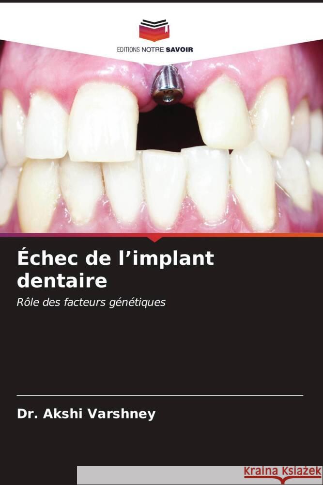 ?chec de l'implant dentaire Akshi Varshney 9786207139606