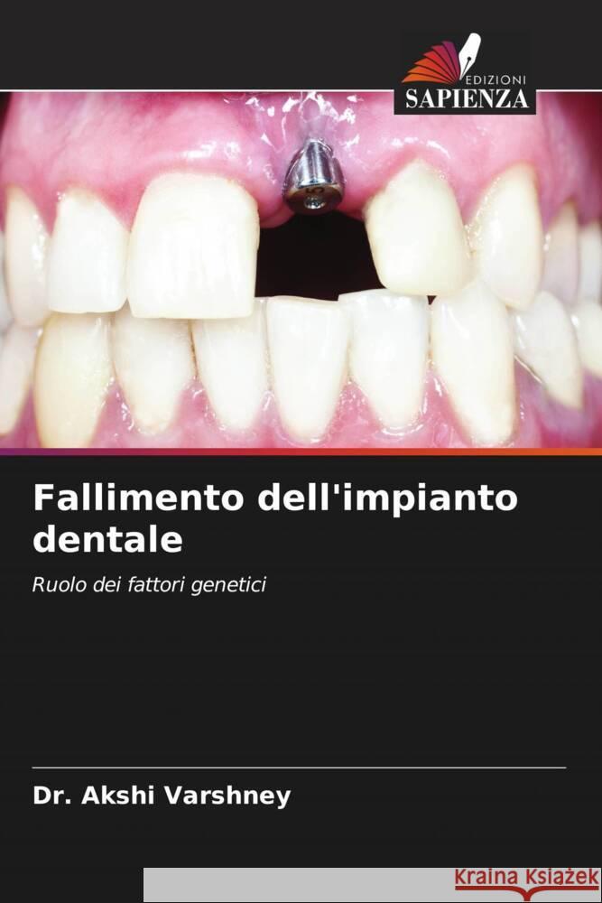 Fallimento dell'impianto dentale Akshi Varshney 9786207139651