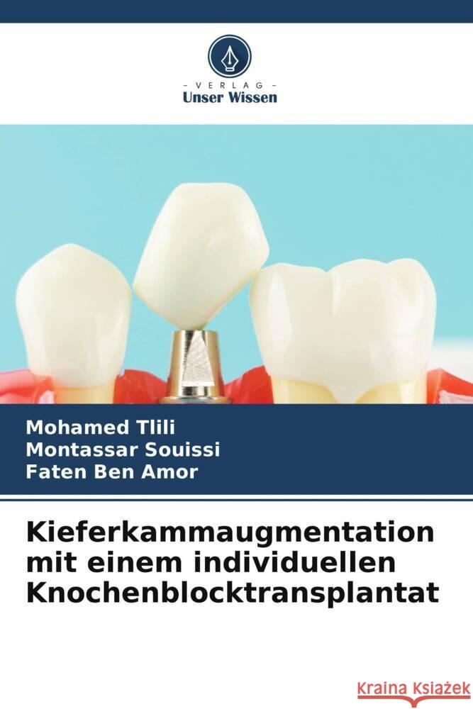 Kieferkammaugmentation mit einem individuellen Knochenblocktransplantat Mohamed Tlili Montassar Souissi Faten Be 9786207162529 Verlag Unser Wissen