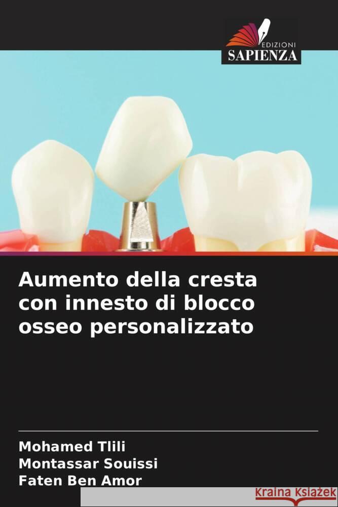 Aumento della cresta con innesto di blocco osseo personalizzato Mohamed Tlili Montassar Souissi Faten Be 9786207162550 Edizioni Sapienza