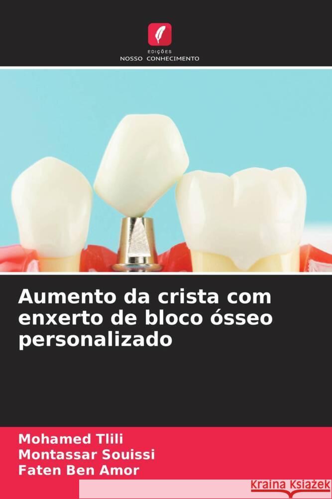 Aumento da crista com enxerto de bloco ?sseo personalizado Mohamed Tlili Montassar Souissi Faten Be 9786207162567 Edicoes Nosso Conhecimento