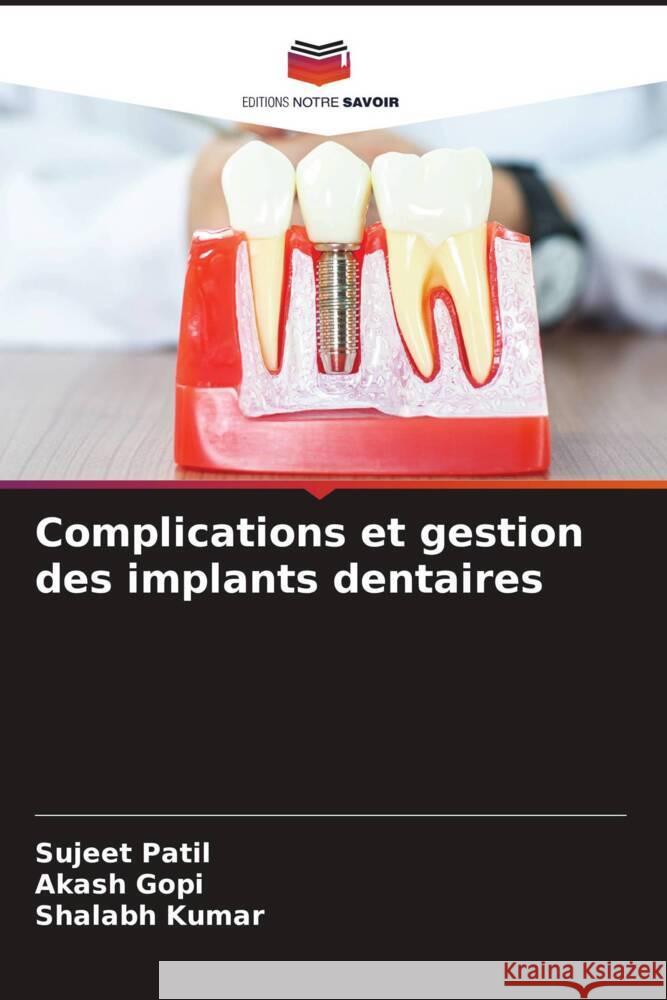 Complications et gestion des implants dentaires Sujeet Patil Akash Gopi Shalabh Kumar 9786207225590