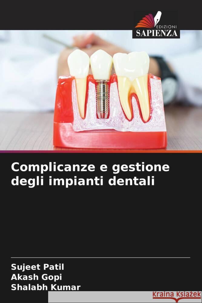 Complicanze e gestione degli impianti dentali Sujeet Patil Akash Gopi Shalabh Kumar 9786207225606