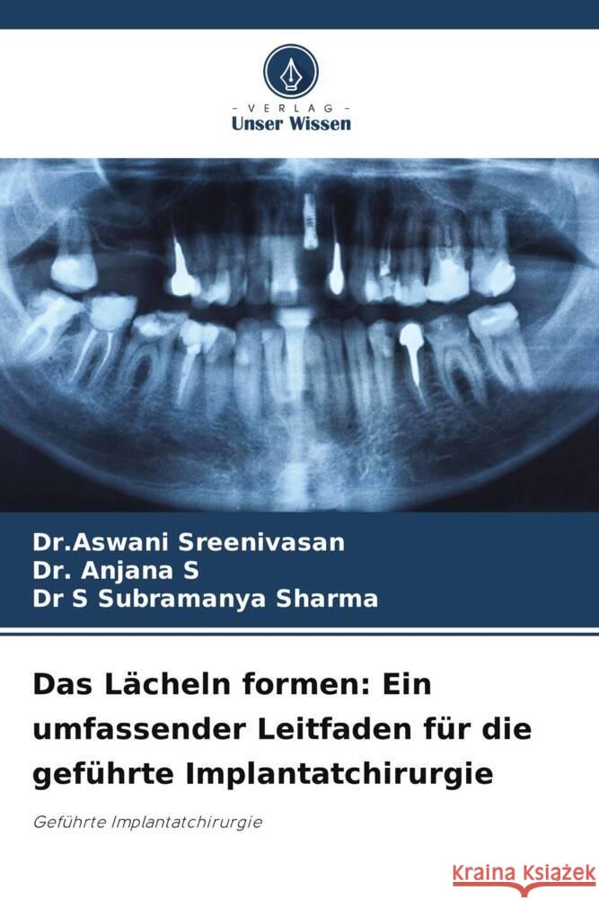 Das L?cheln formen: Ein umfassender Leitfaden f?r die gef?hrte Implantatchirurgie Dr Aswani Sreenivasan Anjana S S. Subramanya Sharma 9786207308873