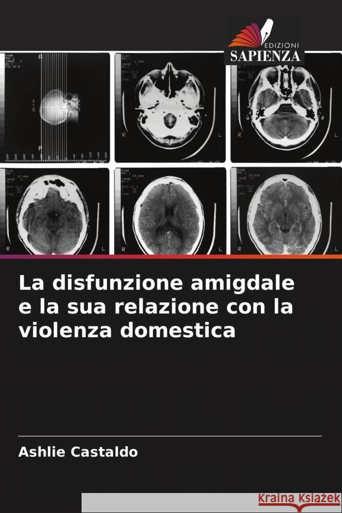 La disfunzione amigdale e la sua relazione con la violenza domestica Ashlie Castaldo 9786207313792 Edizioni Sapienza