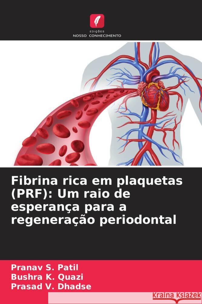 Fibrina rica em plaquetas (PRF): Um raio de esperan?a para a regenera??o periodontal Pranav S. Patil Bushra K Prasad V. Dhadse 9786207373314