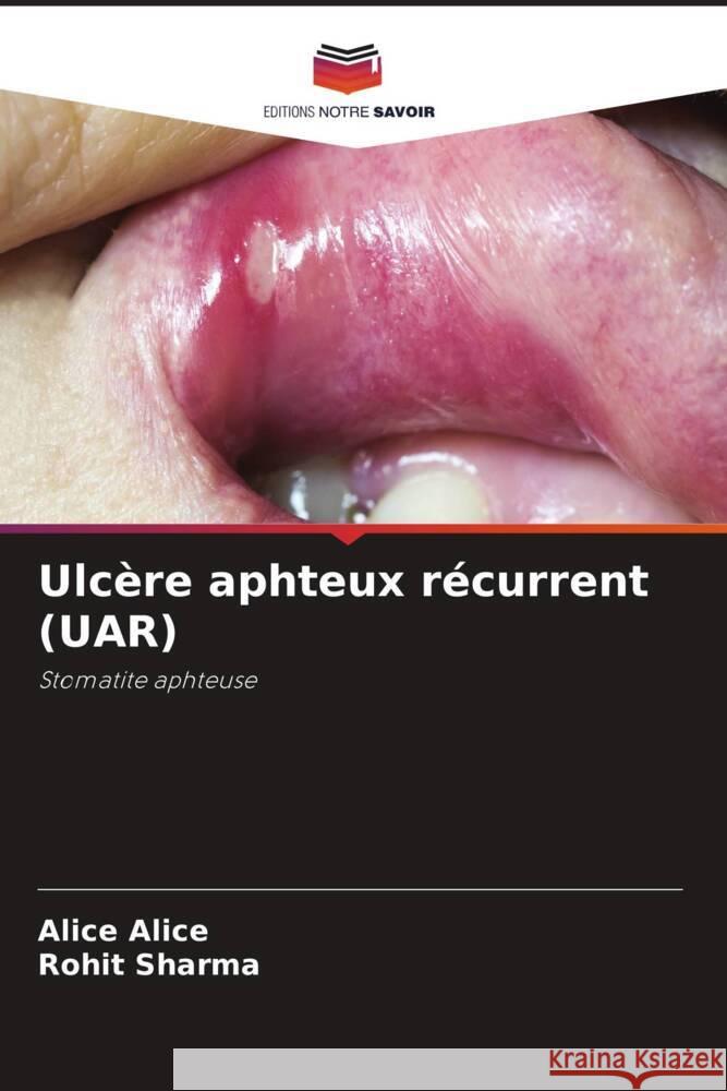 Ulc?re aphteux r?current (UAR) Alice Alice Rohit Sharma 9786207418855 Editions Notre Savoir