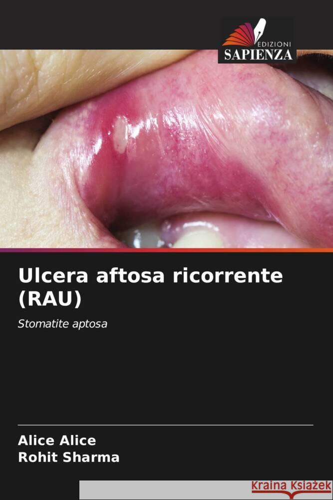 Ulcera aftosa ricorrente (RAU) Alice Alice Rohit Sharma 9786207418862 Edizioni Sapienza