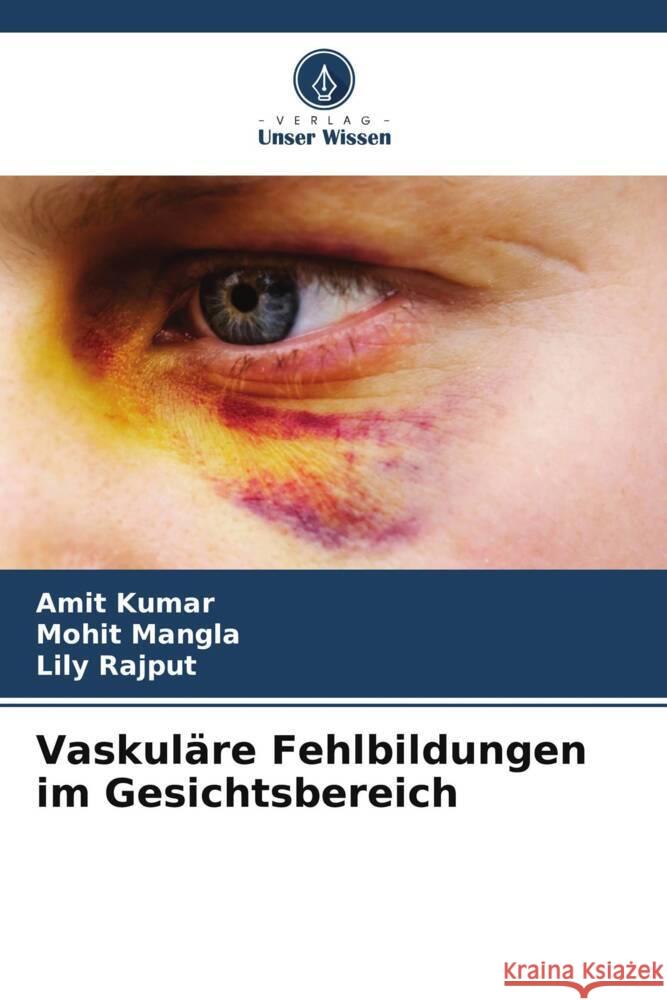 Vaskul?re Fehlbildungen im Gesichtsbereich Amit Kumar Mohit Mangla Lily Rajput 9786207434503 Verlag Unser Wissen