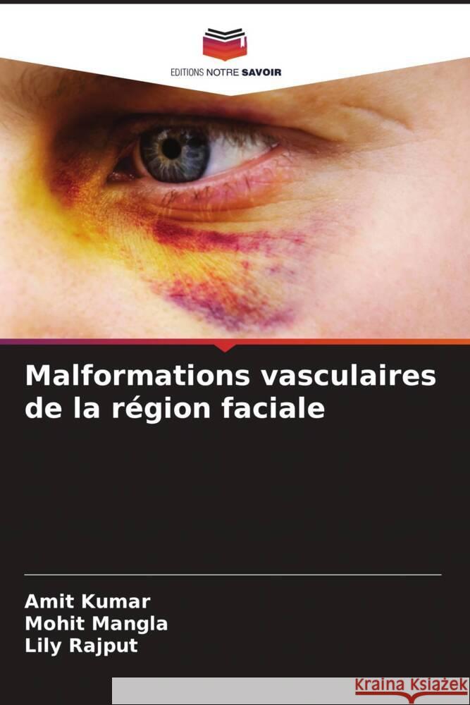 Malformations vasculaires de la r?gion faciale Amit Kumar Mohit Mangla Lily Rajput 9786207434527 Editions Notre Savoir