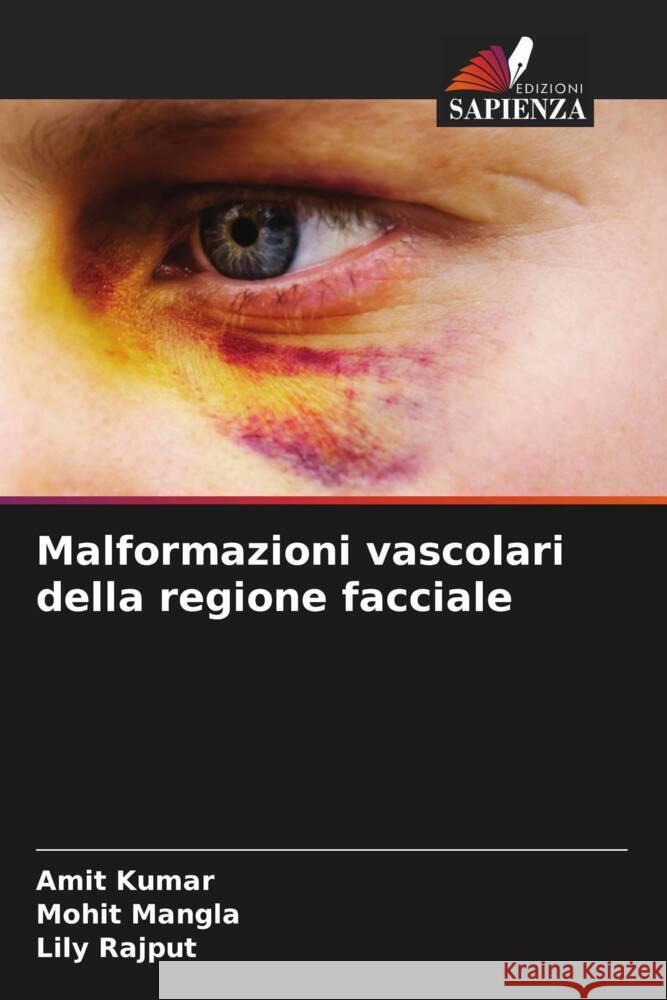 Malformazioni vascolari della regione facciale Amit Kumar Mohit Mangla Lily Rajput 9786207434534 Edizioni Sapienza