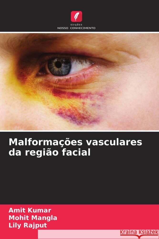 Malforma??es vasculares da regi?o facial Amit Kumar Mohit Mangla Lily Rajput 9786207434541 Edicoes Nosso Conhecimento