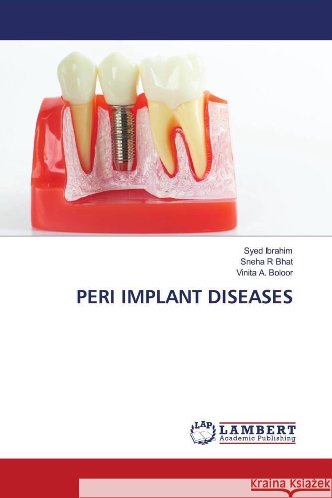 Peri Implant Diseases Syed Ibrahim Sneha R. Bhat Vinita A. Boloor 9786207471041