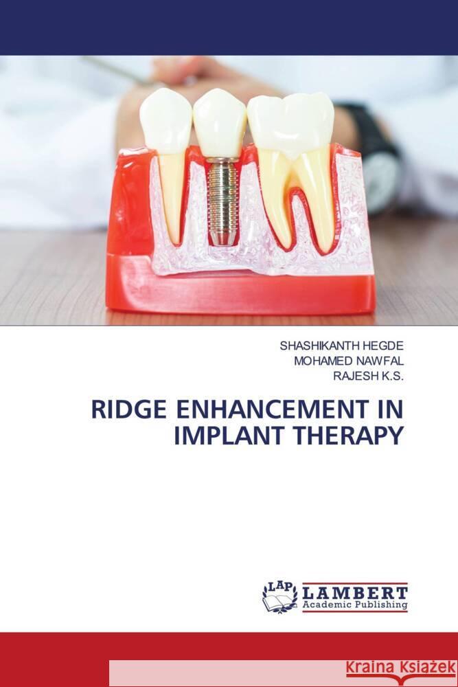 RIDGE ENHANCEMENT IN IMPLANT THERAPY Hegde, Shashikanth, NAWFAL, MOHAMED, K.S., Rajesh 9786207483518