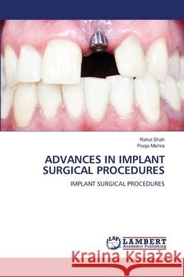 Advances in Implant Surgical Procedures Rahul Shah Pooja Mishra 9786207640935